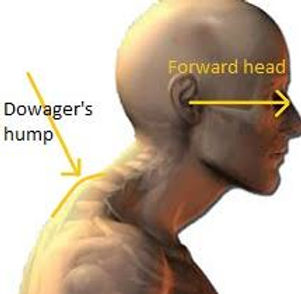 How My Bad Neck Posture Impact My C2 Vertebrae