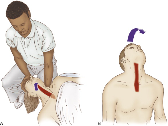 How did My Forward Head Posture Weaken My Longus Colli Muscles