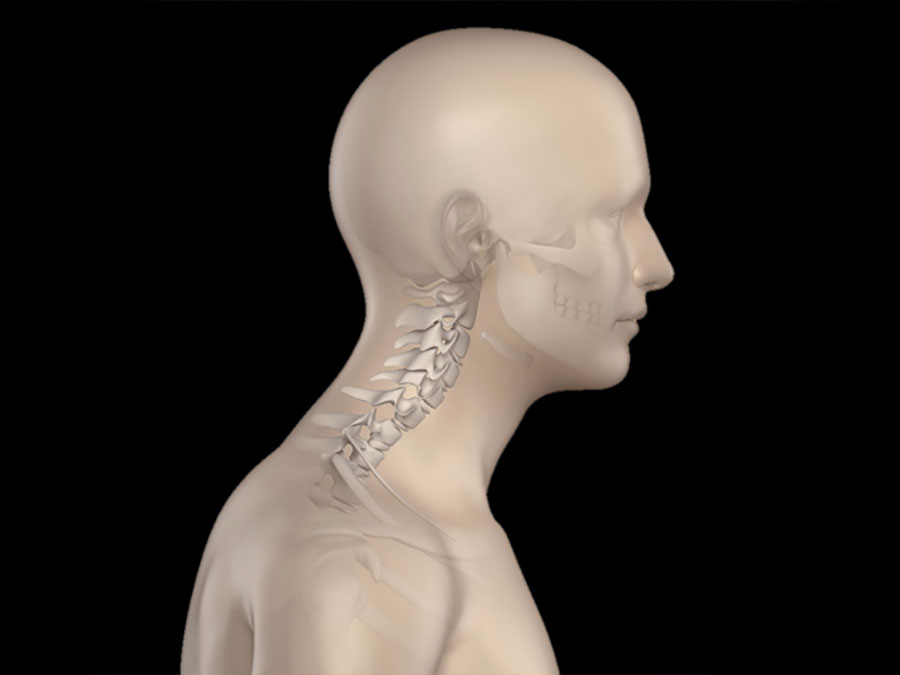 How My Forward Neck Posture Affected My C5 Vertebrae