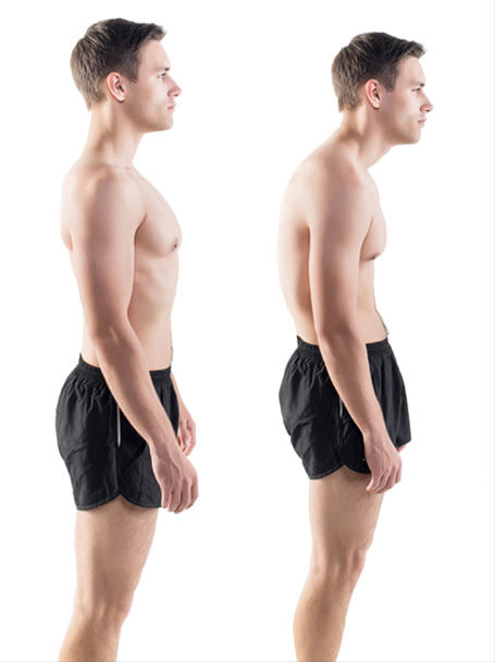 How Forward Head Posture Affected My Rectus Capitus Anterior Muscle