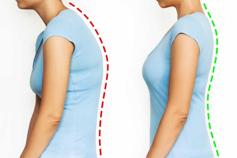 Does Posture Correction Really Fix Forward Head Posture