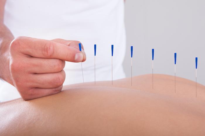 Can Needle Insertion Therapy Really Fix Forward Head Posture