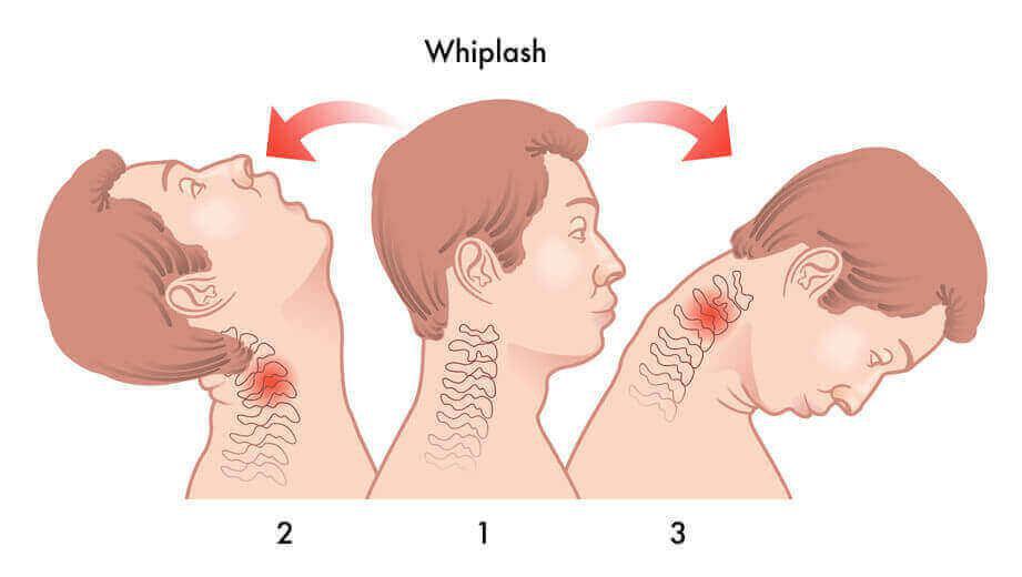 How Whiplash Injury Leads to Forward Head Posture