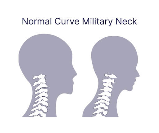 How Military Neck Posture Affects Jaw Alignment