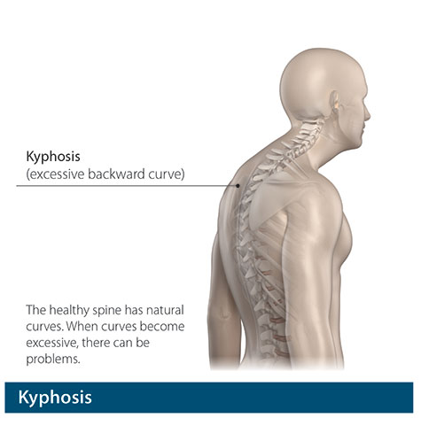 How Cervical Kyphosis Strains Shoulder Muscles