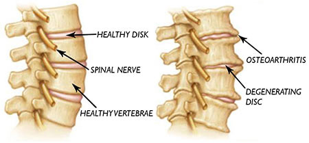 How Degenerative Disc Disease Affects Neck Alignment