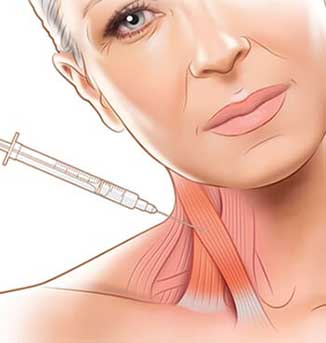 How Botox Injections Relax Neck Muscles for Better Posture