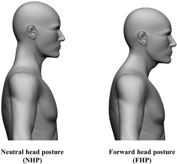 How Forward Head Posture Affects Nasal Airflow