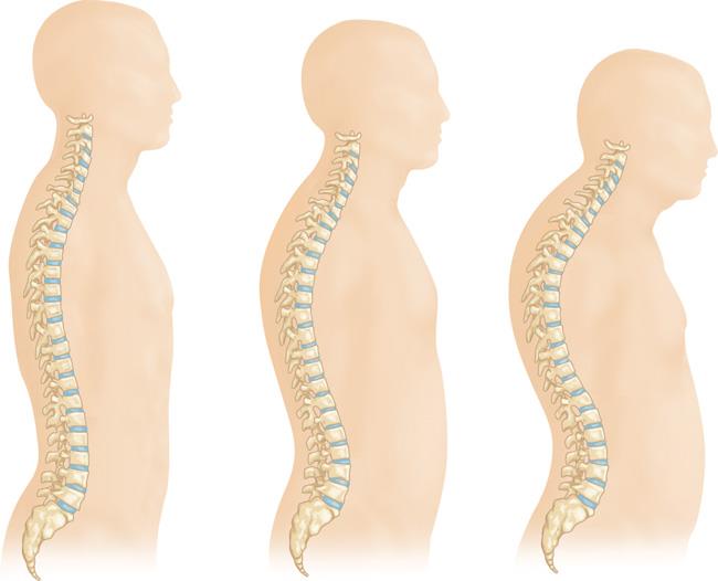 How Osteoporosis Changes Spinal Curvature and Head Posture