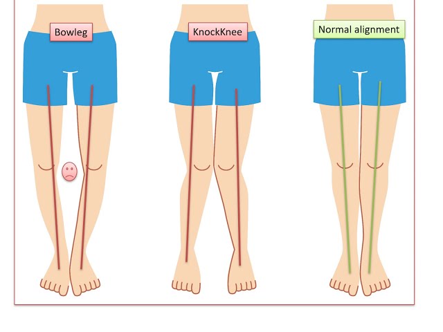 How Forward Head Alters Thigh Alignment During Walking