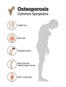 Introduction to Osteoporosis and Its Impact on the Spine