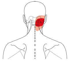 Acupuncture Points for Headaches and Neck Pain