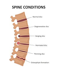 How Degenerative Disc Disease Affects the Cervical Spine