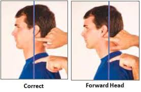 Introduction to Neck Posture Issues