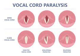 The Anatomy of Voice Production and Neck Posture