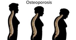 Mechanisms Behind Spinal Curvature Changes