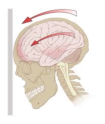 Concussion and forward head posture