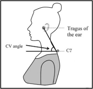 The Importance of Assessing Neck Alignment