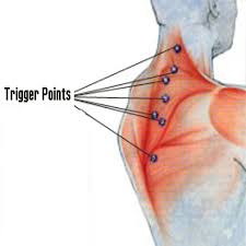 How Trigger Point Injections Alleviate Muscle Tension in the Neck