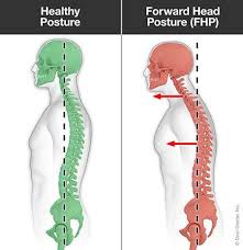 How I Discovered My Forward Neck