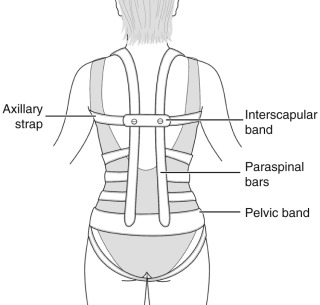 How Orthotics Stabilize the Spine