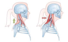 Why are Millions across the Globe Suffering from Forward Head Posture