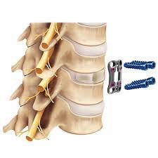 Understanding Anterior Cervical Discectomy and Fusion