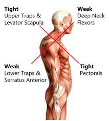 How Neck Posture Leads to Muscle Strain