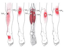 How Forward Head Posture Creates Muscle Tension in the Calves