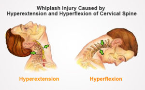 The Biomechanics of a Whiplash Injury