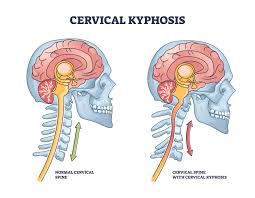 How Cervical Spine Curvature affects Shoulder Symmetry