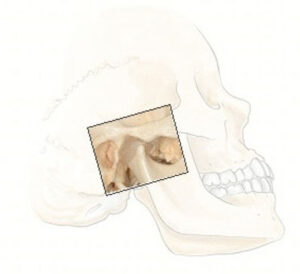Treatment Strategies for Jaw Stiffness Due to Military Neck Posture