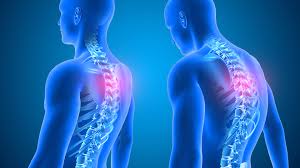 Role of Trapezius and Scapular Imbalance