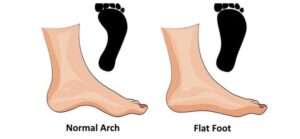 how vulture neck posture causes flat feet