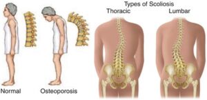 How Forward Leaning Neck Impacts Your Cervical Spine