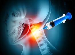 how Posterior Cervical Laminectomy fixes vulture neck posture