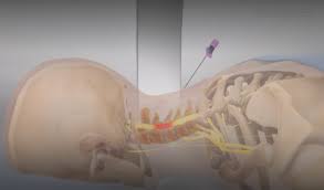 How Cortisone Injections Reduce Inflammation in Cervical Spine Joints