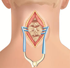 How Posterior Cervical Laminectomy Decompresses Nerves for Better Alignment