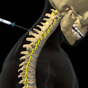 how Cortisone Injections improve head and neck posture