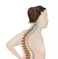 How Genetic Spinal Curvature Affects Neck Posture