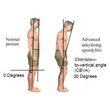 Why Forward Head Tilt Develops in Ankylosing Spondylitis