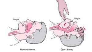 Postural Adaptations: Forward Head Posture and Nasal Airway Impact